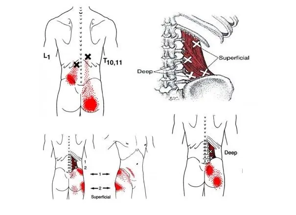 Quadratus Lumborum Trigger Points