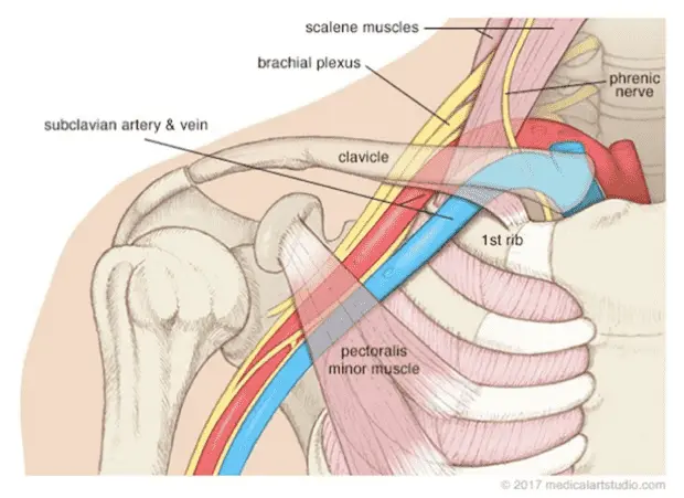 Thoracic Outlet Syndrome